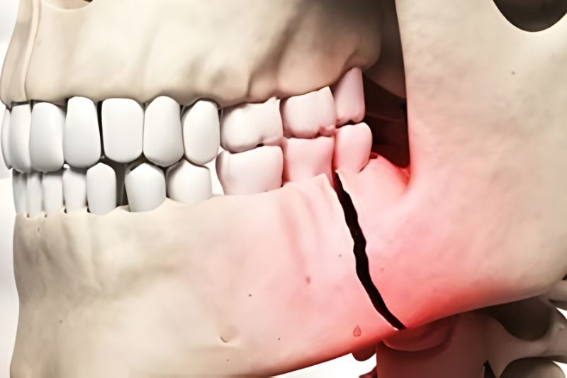 Facial and Jaw Fracture Plastic surgery